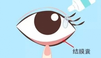 疫情期間，近視手術(shù)術(shù)后應(yīng)該如何保養(yǎng)?