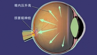 叮咚！您有一份關(guān)于青光眼的全解指南，請注意及時查收！