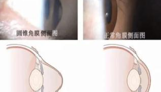 度數(shù)長得快，有時候并不是近視的原因哦！